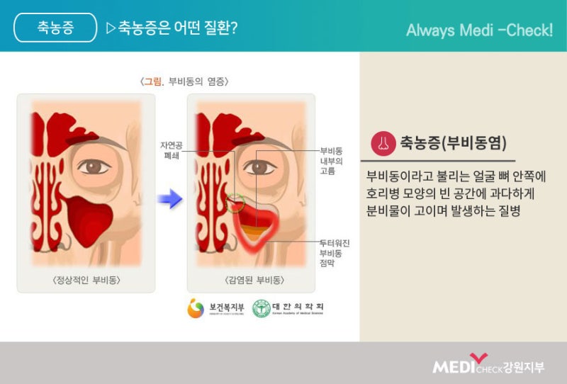 오늘은 무슨 차 마실래?) 너무 힘든 비염, 축농증, 기침, 가슴통증, 코가 깨끗하면 삶의 질 향상