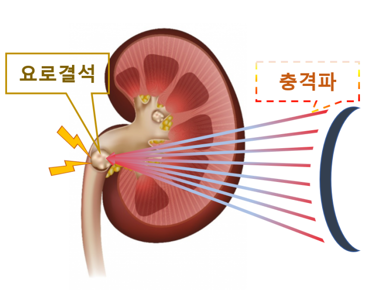  [울산 비뇨기과] 요로결석 치료, 체외충 격파 쇄석술 (ESWL)이 뭔가요?