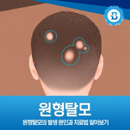 마포탈모 원형탈모 발생 원인과 치료법을 꼼꼼히 알아둔다.