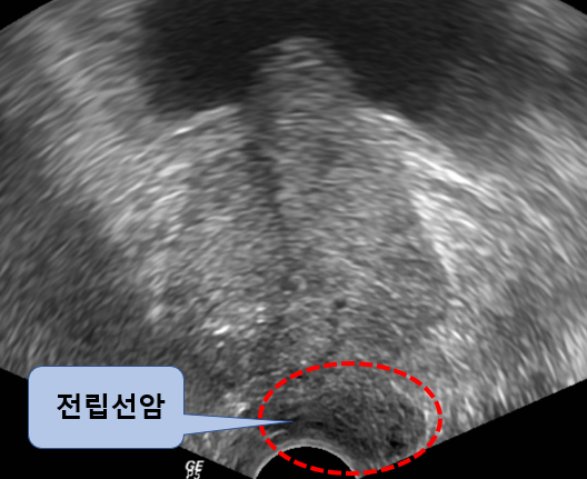  전립선 초음파를 항문을 통해 시행하는 이유