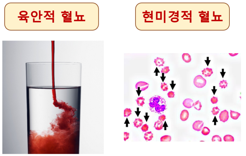 남자 소변에서 피가 나와요. 붉은