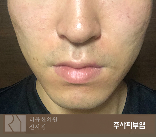  주사피부염 환자를 위한 세안제, 세안방법