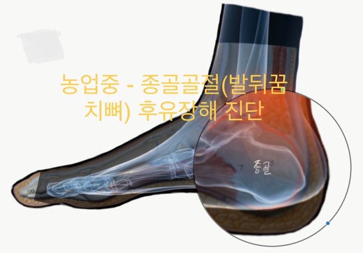  보상사례-농업중 종골골절(발꿈치뼈)