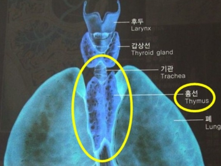  흉선암 이란 !?