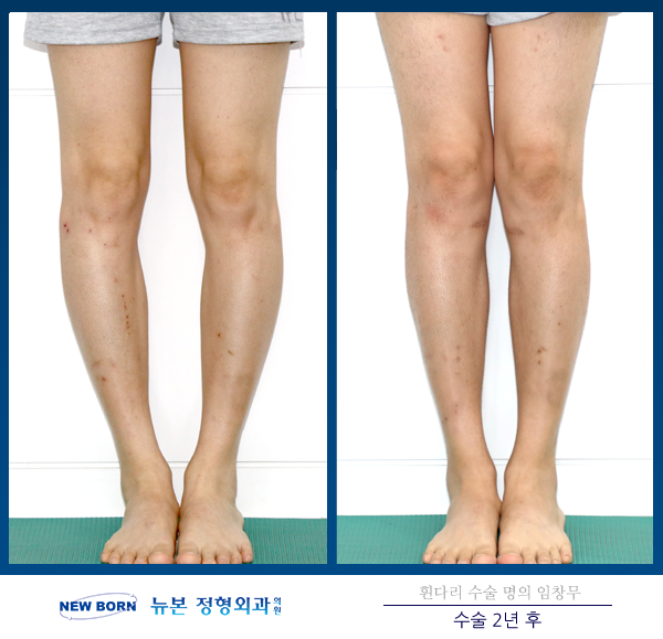 오다리 60대에 수술한 이유 | 2642