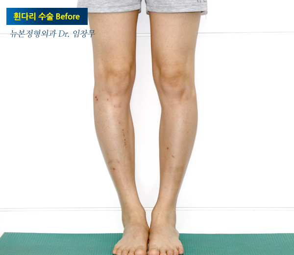 오다리 60대에 수술한 이유 | 2642 2