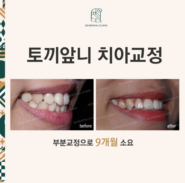 앞니 부분 교정 후기? 현직 의사가 공개 <필독>*