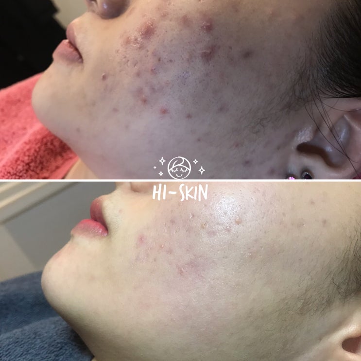  볼트러블 턱드름은 압출잘하는곳 구로디지털단지피부관리실 하이스킨