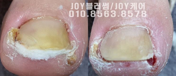  용인 발톱염증으로 보행이 불편한 고객님이 선택한 네일샵 조이블러썸