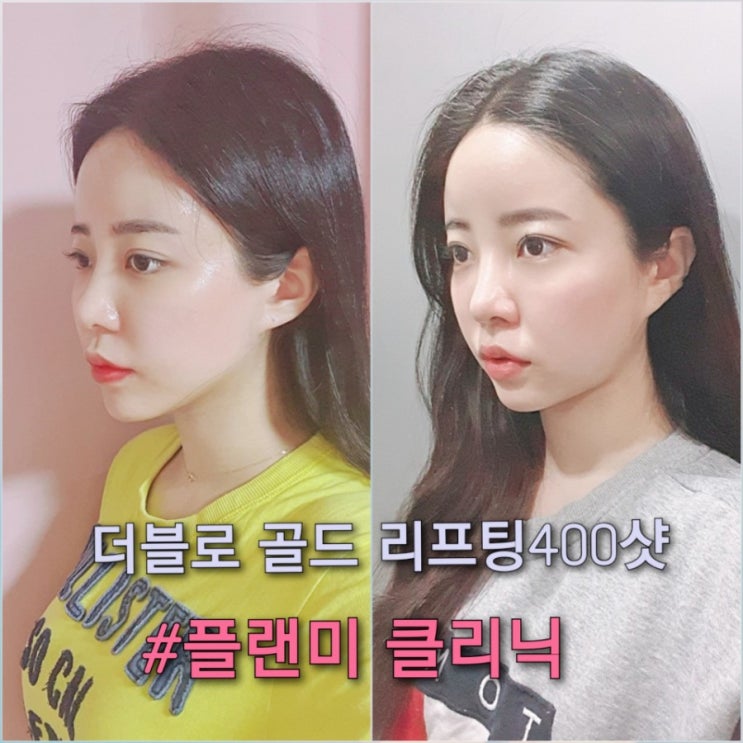  "플랜미 의원"에서 더블로 골드 리프팅 400샷하고 이중턱+턱라인 정리된 후기!