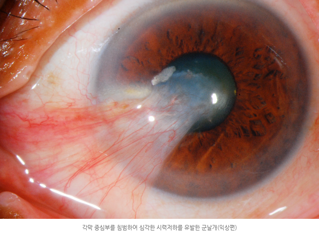 익상편(군날개)란? 원인, 증상, 치료