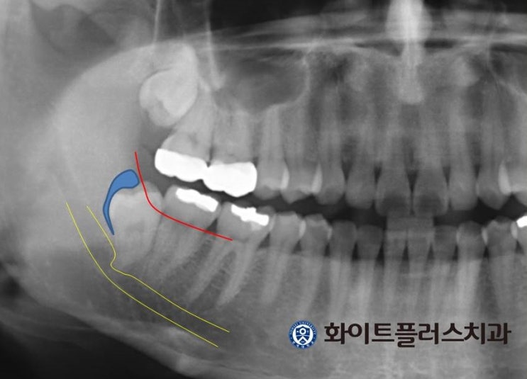  염증생긴 매복 사랑니의 발치는 신대방동치과에서