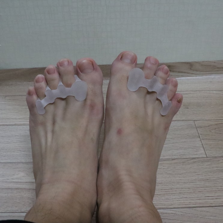  무지외반증 발가락교정기 / 의료기기 제조 회사에서 개발한 발가락 교정용부목 네오 발미소