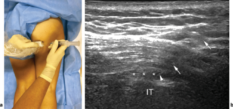 [통증/골반] 의자에 앉으면 엉덩이가 아파요. - 좌골점액낭염(Ischial bursitis) : 네이버 블로그