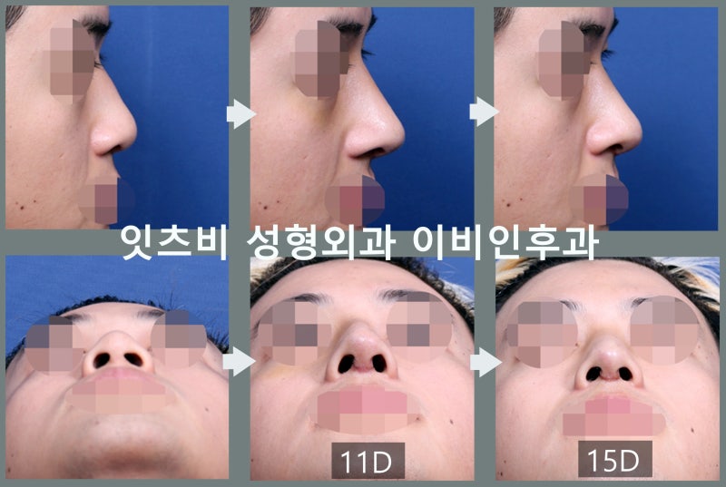 [정석성형외과 케이스 리뷰 22] 코수술 후 발생한 심한 비염 환자에게서 제대로 된 코 실리콘 제거 수술을 보여드리겠습니다.