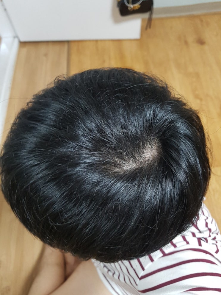  탈모치료 1년후기 먹는 탈모약 변경 해보자