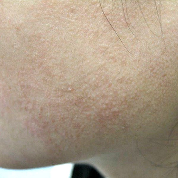 팔다리얼굴모공각화증케어 소름돋는피부 매끈하게만드는법 4