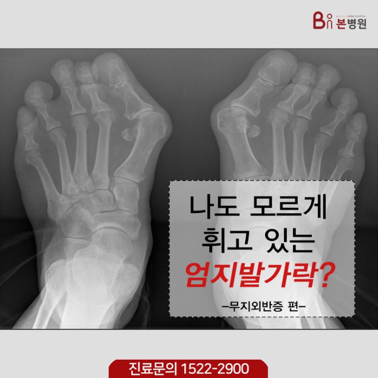  안양역 앞 정형외과, 안양 본병원에서 무지외반증에 대해 알려드려요