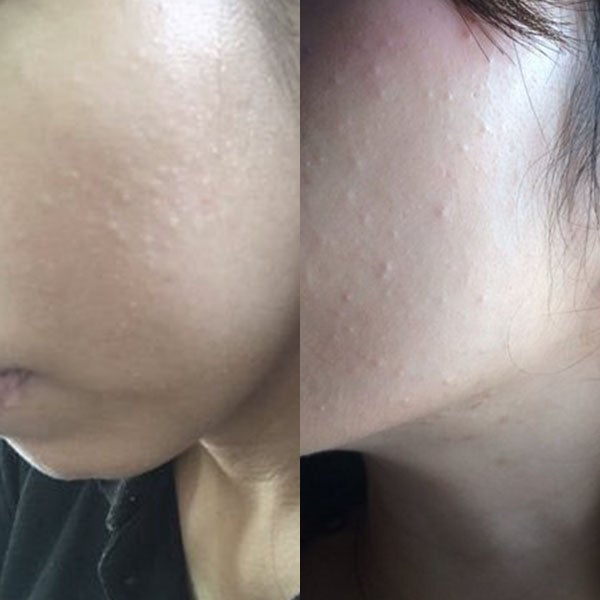 팔다리얼굴모공각화증케어 소름돋는피부 매끈하게만드는법 1