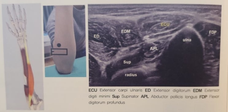  척측수근신근 위치 및 통증 (Extensor carpi ulnaris)