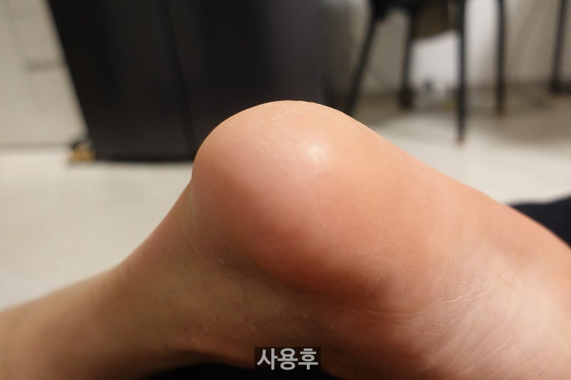 [도도풋케어] 글라스 발각질제거기 사용 후기 비포 에프터 ★
