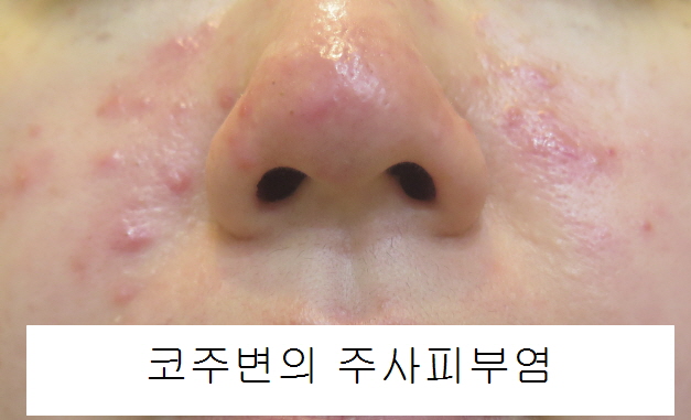  주사피부염 환자를 위한 보습제, 보습방법