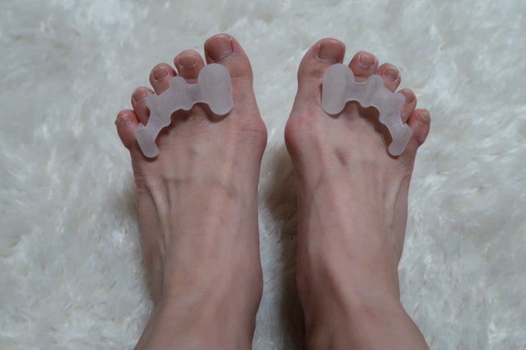  ‘ 네오메드 발가락교정기 ’로 무지외반증 악화 막기