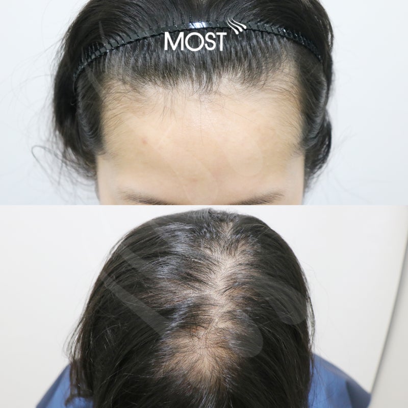 여자 앞머리 탈모가 빠지기 시작했나요? 9