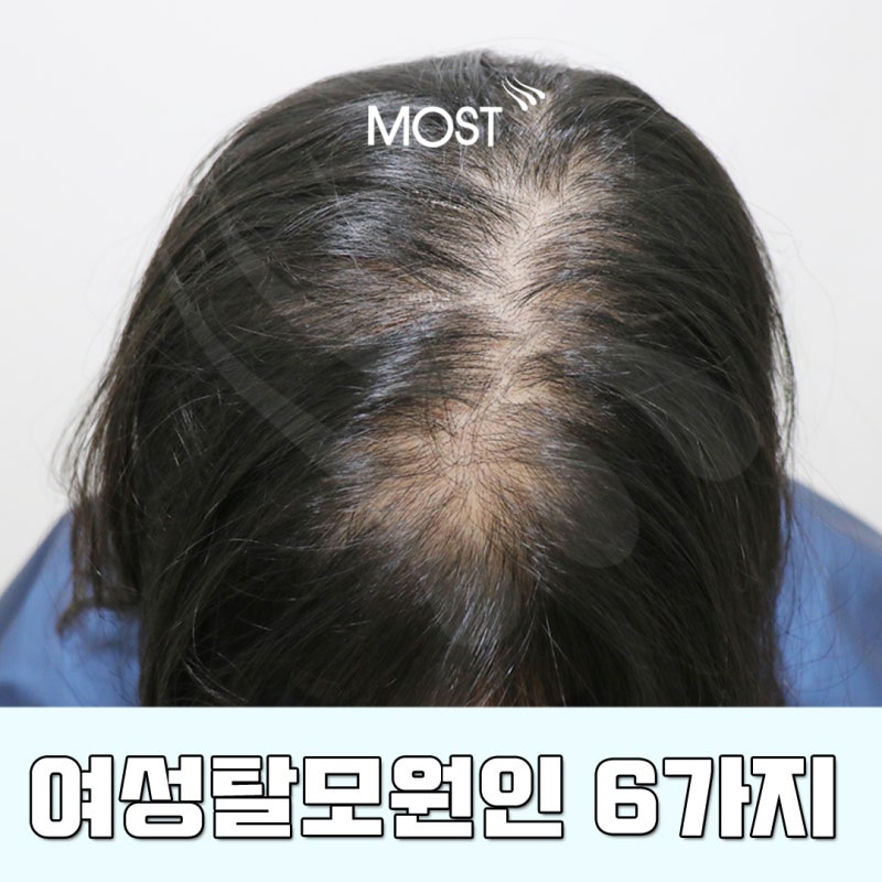 여자 앞머리 탈모가 빠지기 시작했나요? 5