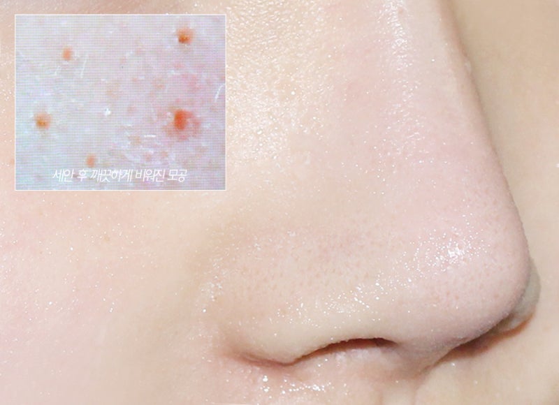 주례피부과 블랙헤드 관리하는 5