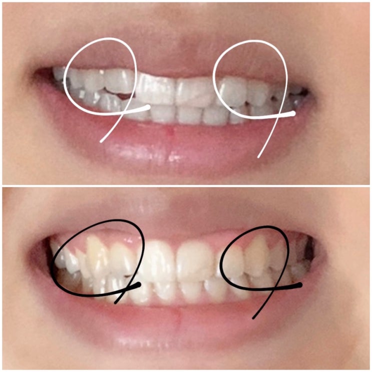 치아미백기계 치아미백에 효과있을까?