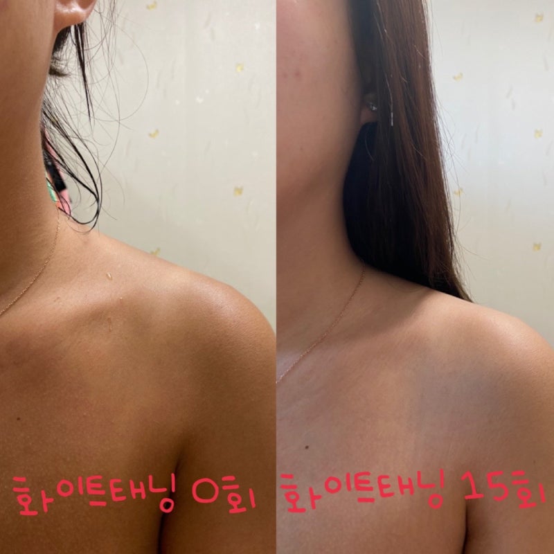 화명동태닝 동남아 여행 후 화이트태닝