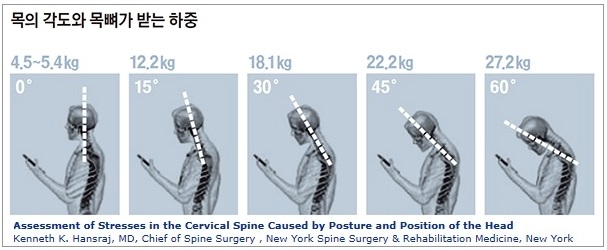  거북목교정자세 정말 꼭 하셔야할 분!