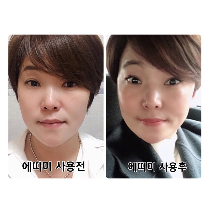 에띠미뱀독2종 쌩얼미인누구나될수있다솔직담백스토리-에띠미광순이 : 네이버 블로그