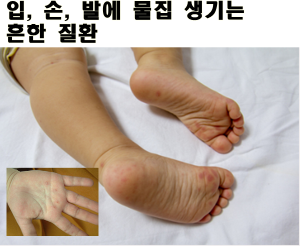  못먹어서 힘든 수족구병