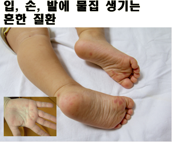 못먹어서 힘든 수족구병