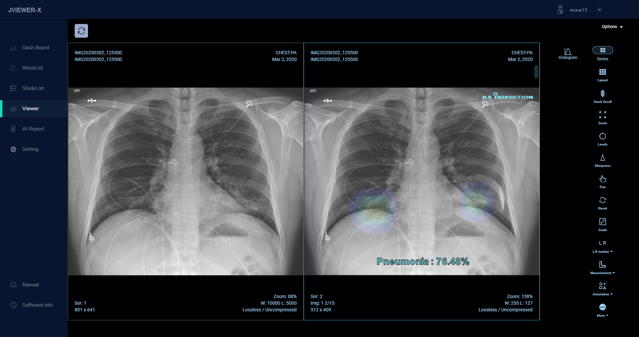  제이엘케이인스펙션, 폐렴 조기 검출을 위한 '흉부  X-ray AI 분석 솔루션'