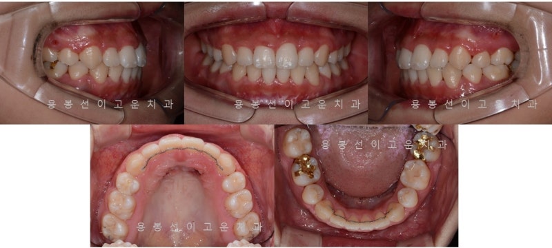 광주치아교정을 올바르게 고친다면 9