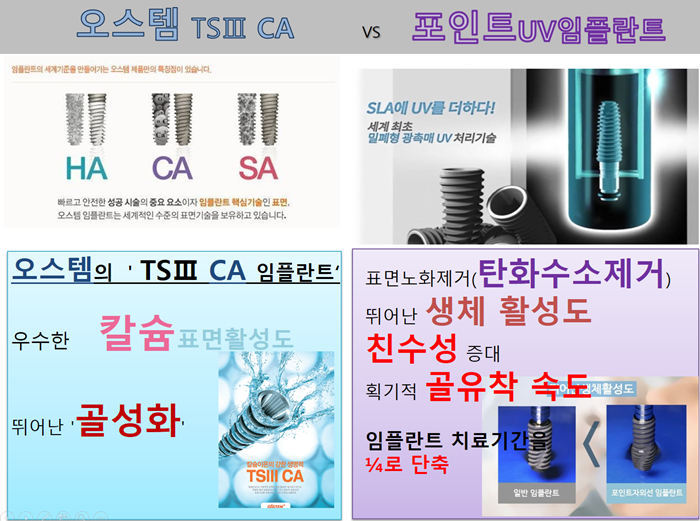  포인트임플란트 어떤점이 좋은가요?