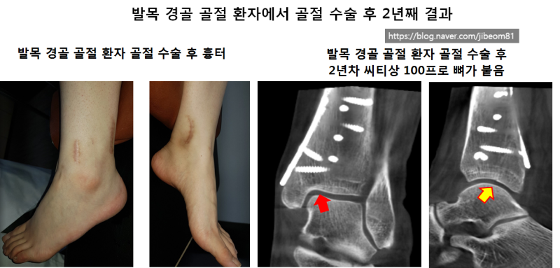 발목의 개방성 골절의 수술적 7
