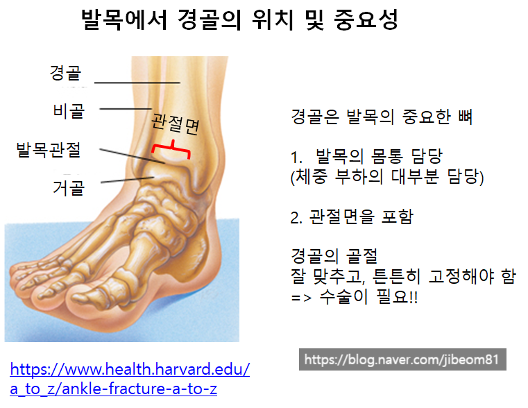 발목 골절 수술 비용은 얼마입니까?  "전문가"가 말했다.