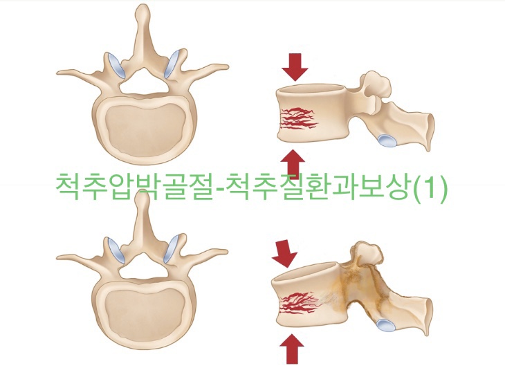 척추압박골절-척추질환과보상(1)