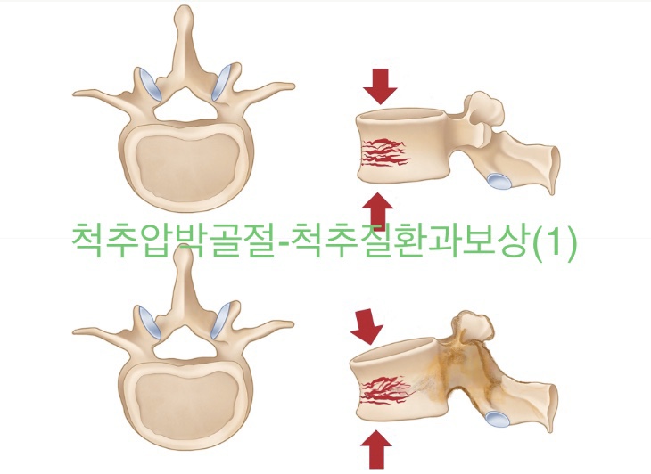  척추압박골절-척추질환과보상(1)