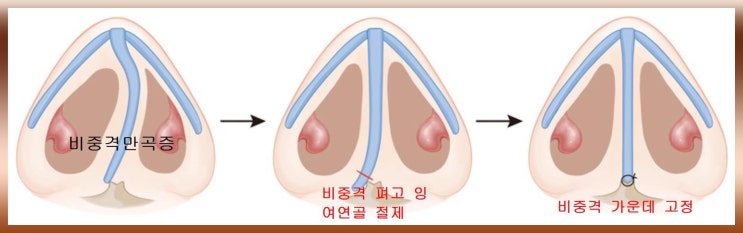  비중격 만곡증