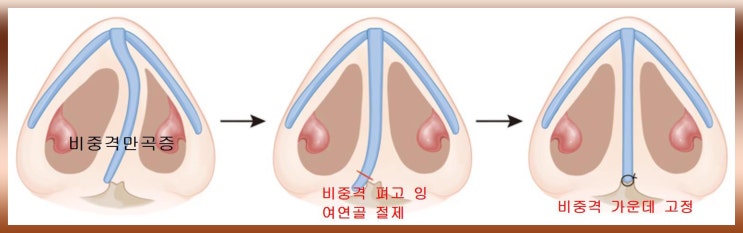 비중격 만곡증