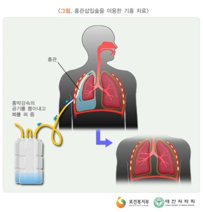 기흉 시술(흉관삽입술) 후기
