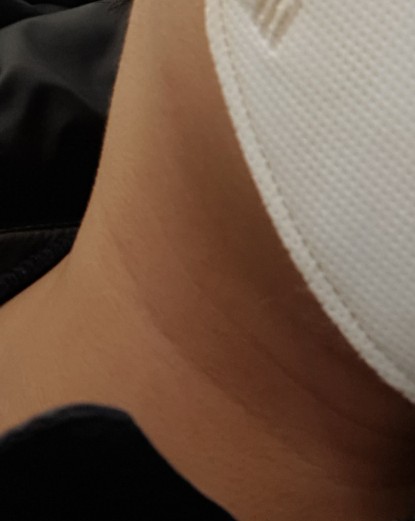  코로나19 말고 임파선염에 대해 알아보자