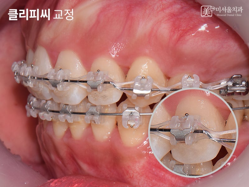 울산치아교정비용 보다는 실력이