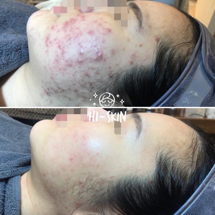  아픈여드름 염증성여드름 얼굴트러블관리는 구로디지털단지피부관리실 하이스킨