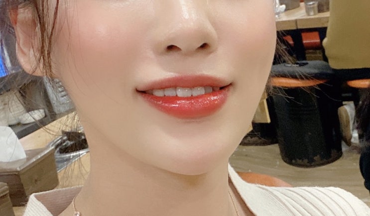  피부과 VVIP가 쓰는 턱필러 후기 (부작용, 통증, 지속기간)